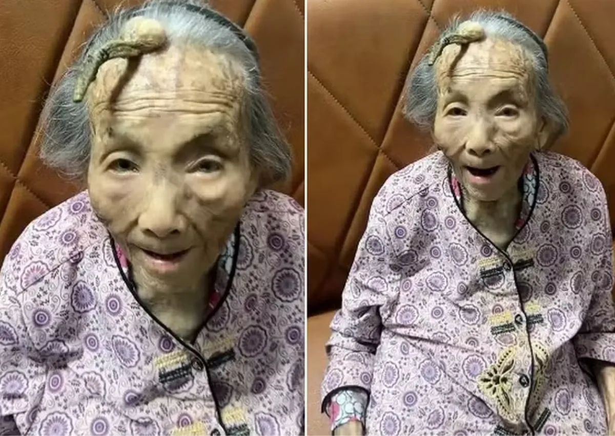 Chinesa tem 'chifre' crescendo na testa