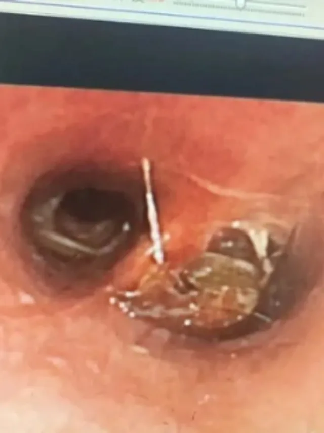 Homem fica com bafo de barata após aspirar inseto enquanto dormia