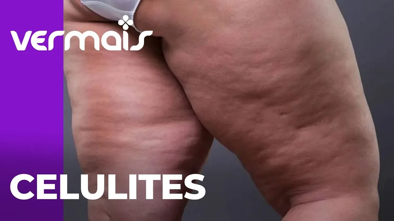 Celulites: Conheça os procedimentos estéticos para o tratamento