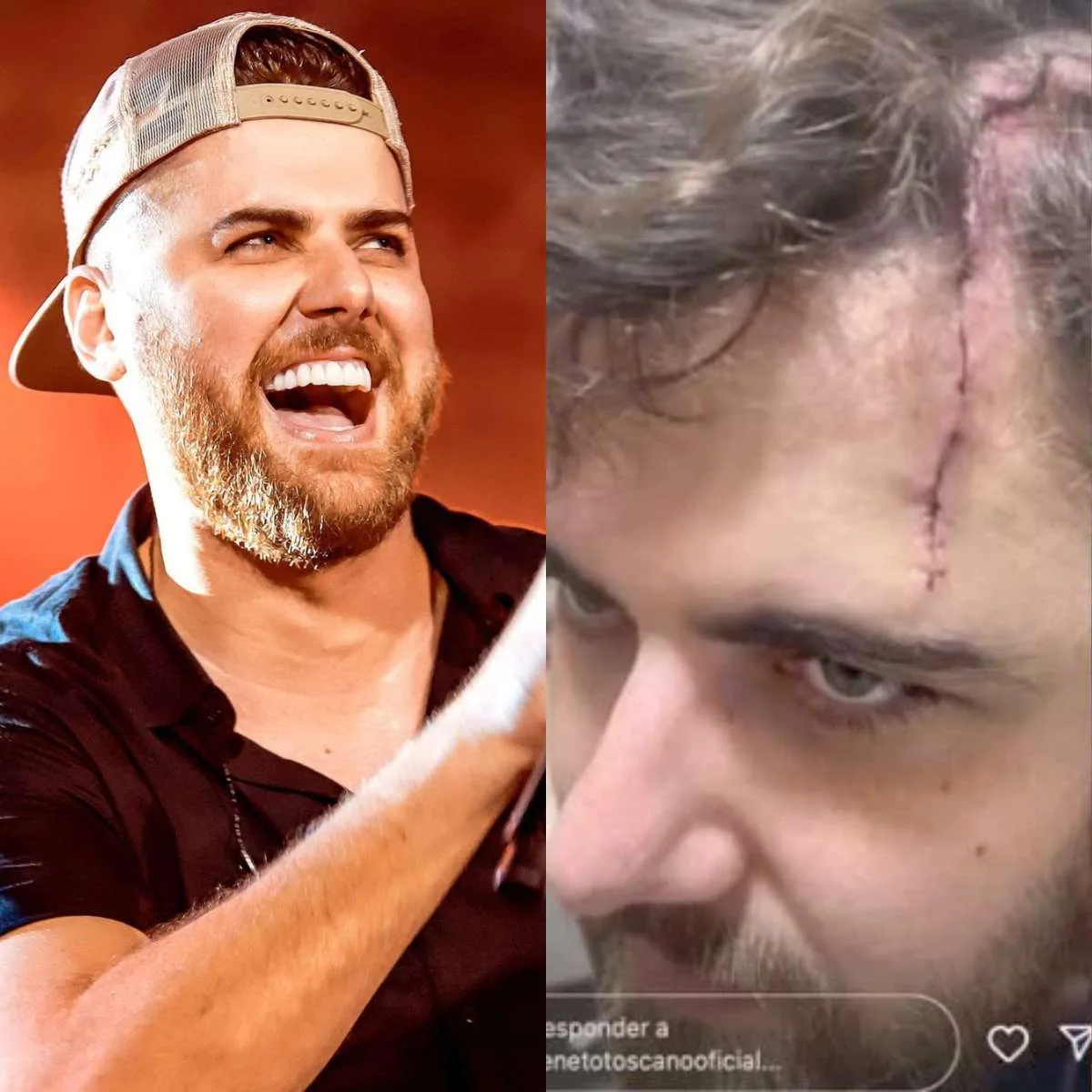 Cantor Zé Neto sofre acidente e mostra cicatriz na cabeça: "Um corte bem grande"