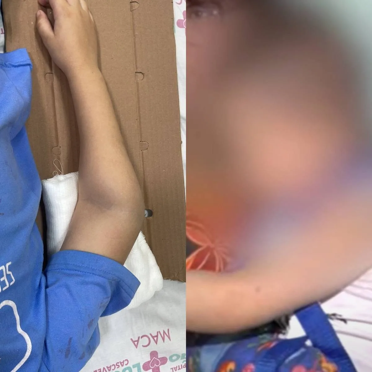 Criança de 3 anos tem braço quebrado por agente de apoio em CMEI de Cascavel