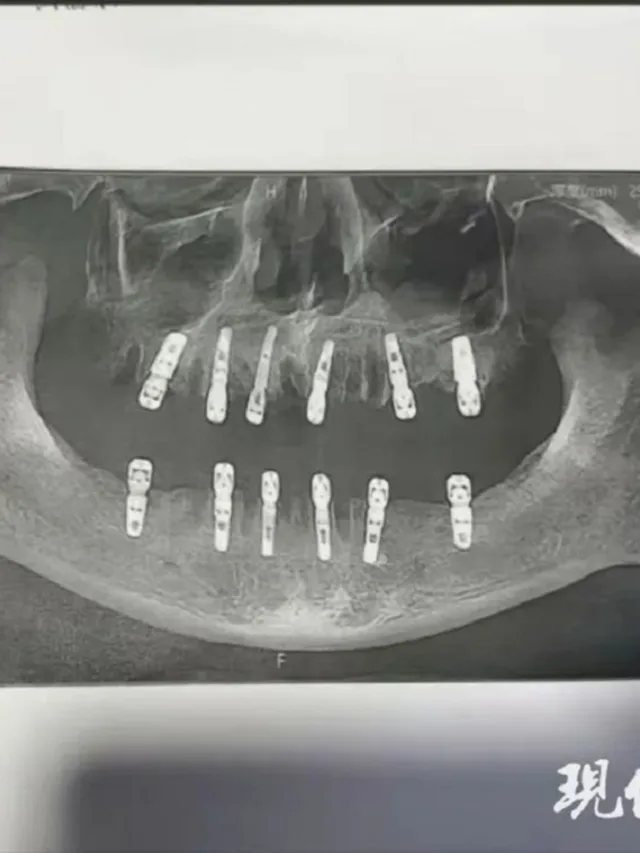 Homem morre 13 dias depois extrair 23 dentes e implantar 12 em cirurgia