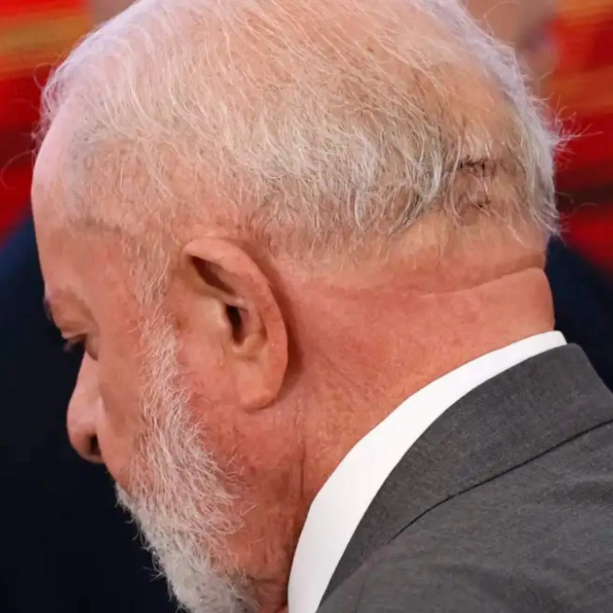 Saiba como é a cirurgia que Lula vai passar nesta quinta-feira (12)