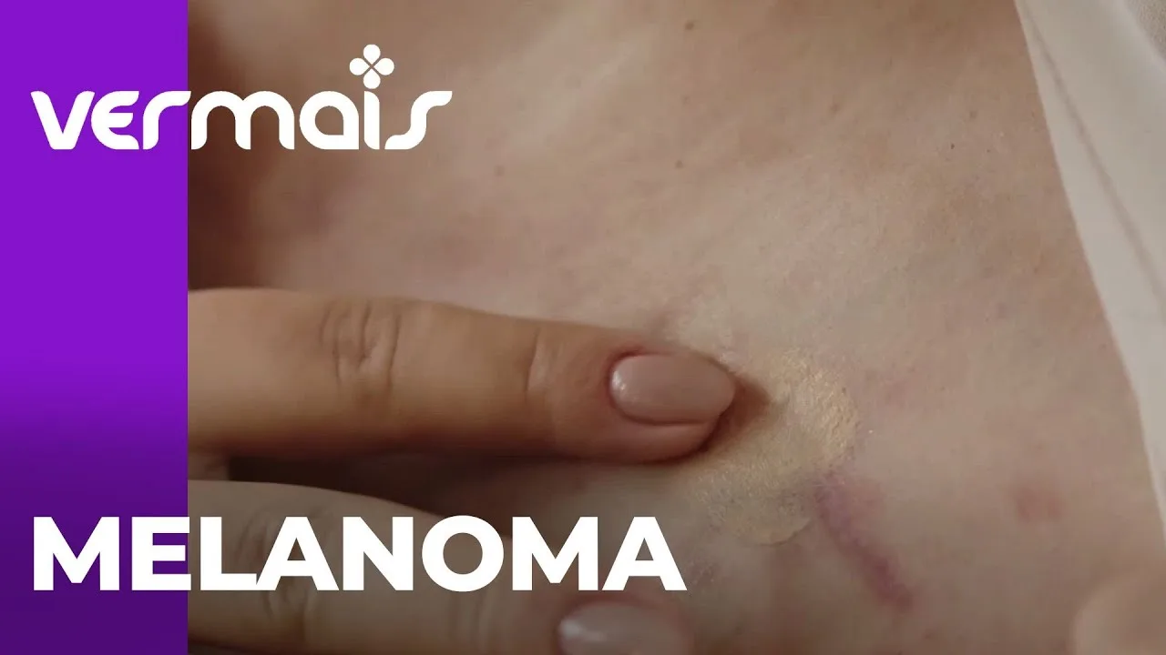 Melanoma: especialista fala como identificar e seu tratamento