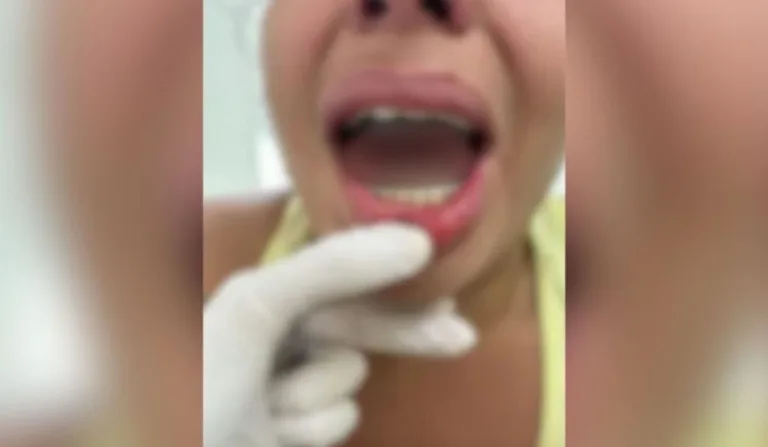 mulher com língua arrancada