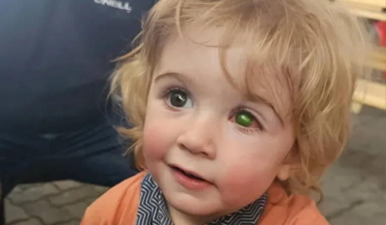 Bebê com herpes no olho