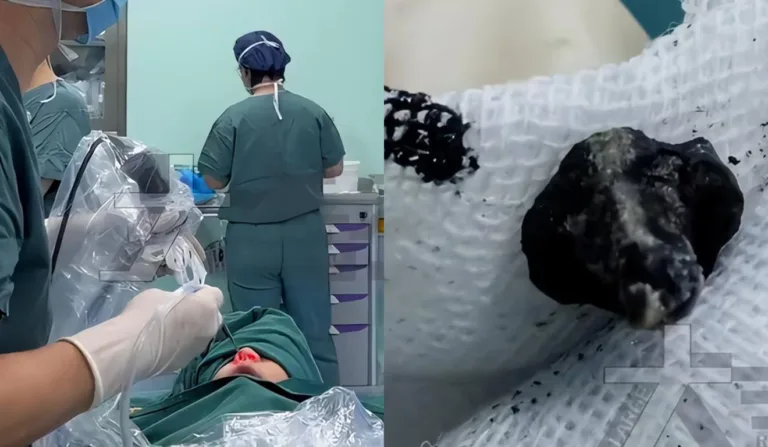 Cirurgia em nariz e parafuso