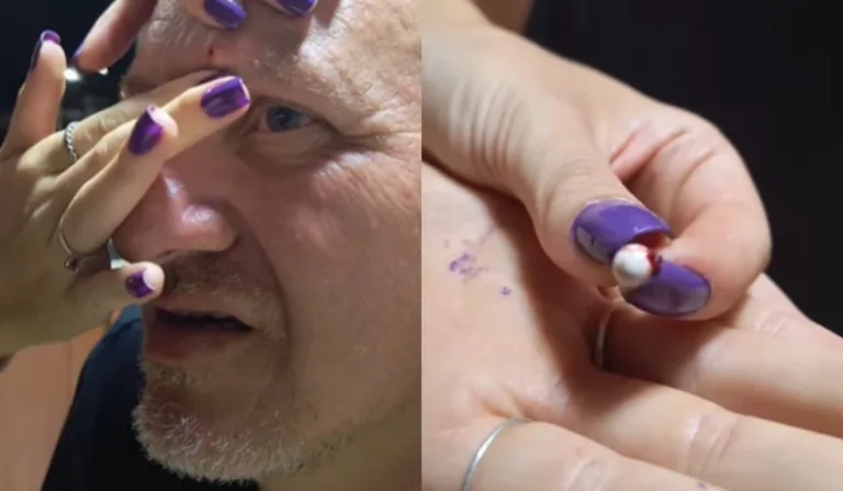 homem com bala presa na testa