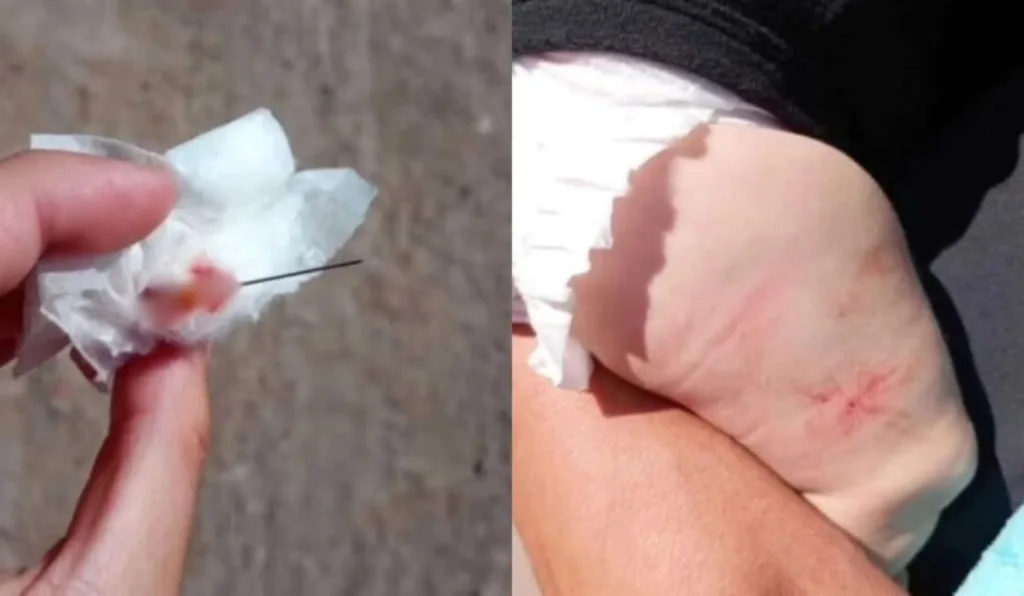 Enfermeira 'esquece' agulha na perna de bebê e mãe percebe ao chegar em casa