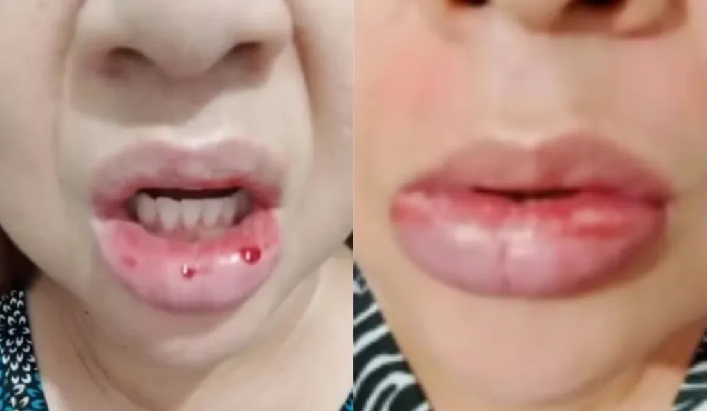 Mulher com os lábios inchados.
