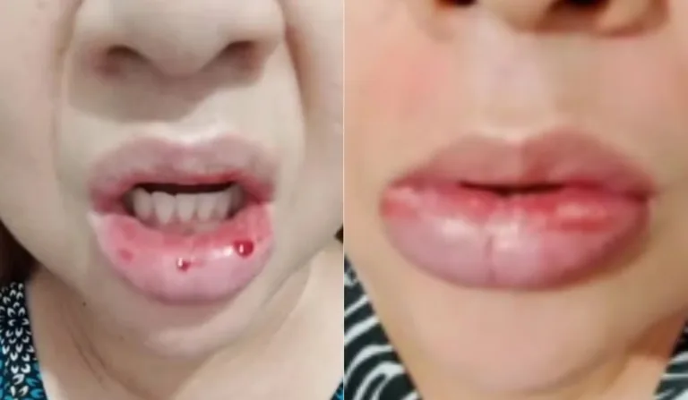 Mulher com os lábios inchados.