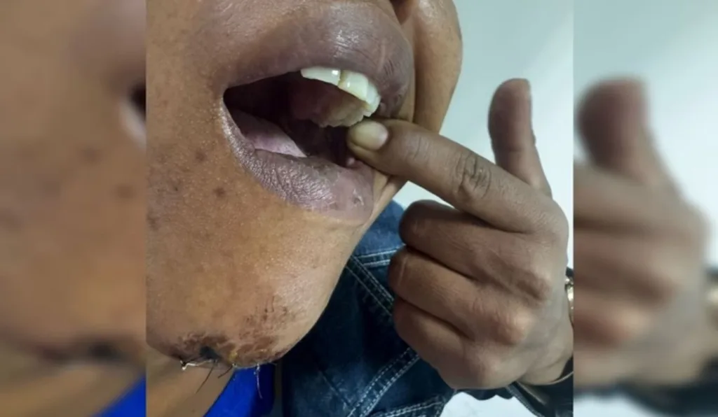 sogra com pontos após ser espancada pelo genro