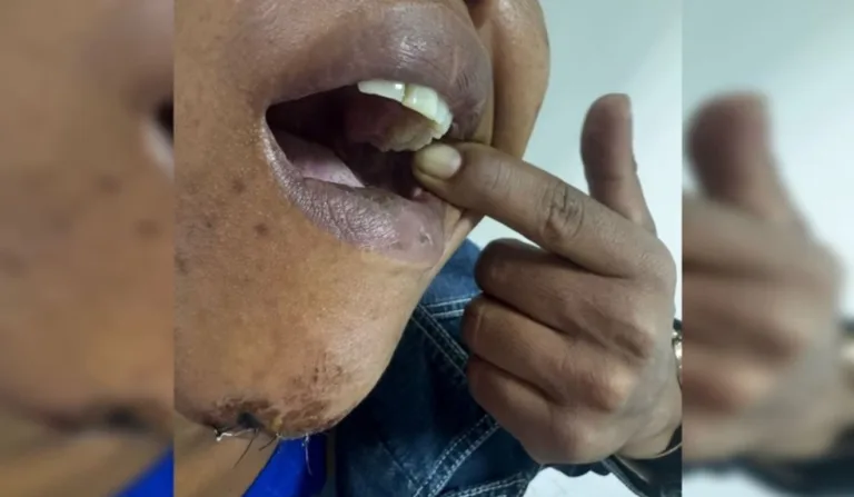 sogra com pontos após ser espancada pelo genro