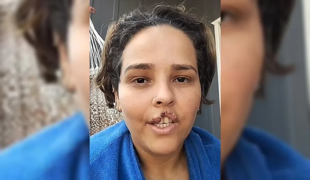 mulher com labio arrancado por cachorro