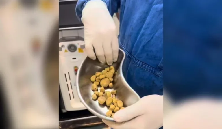 Pedras retiradas da bexiga.