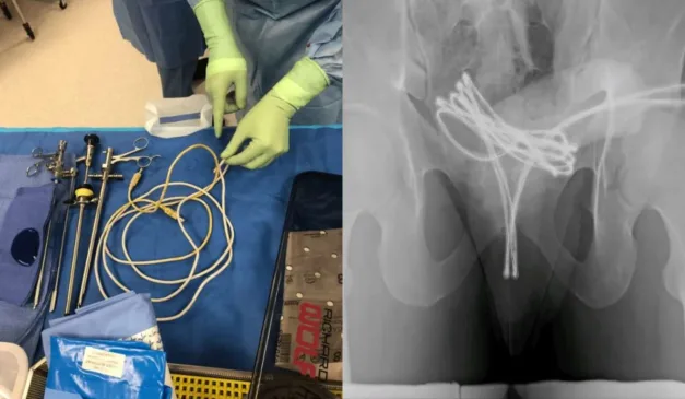 Cabo USB após retirada e objeto em órgão genital