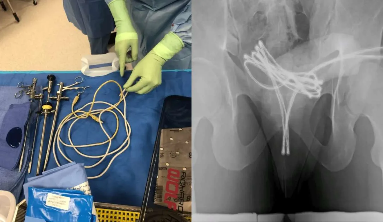 Cabo USB após retirada e objeto em órgão genital