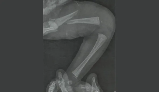 Raio-X de fêmur de recém-nascido quebrado