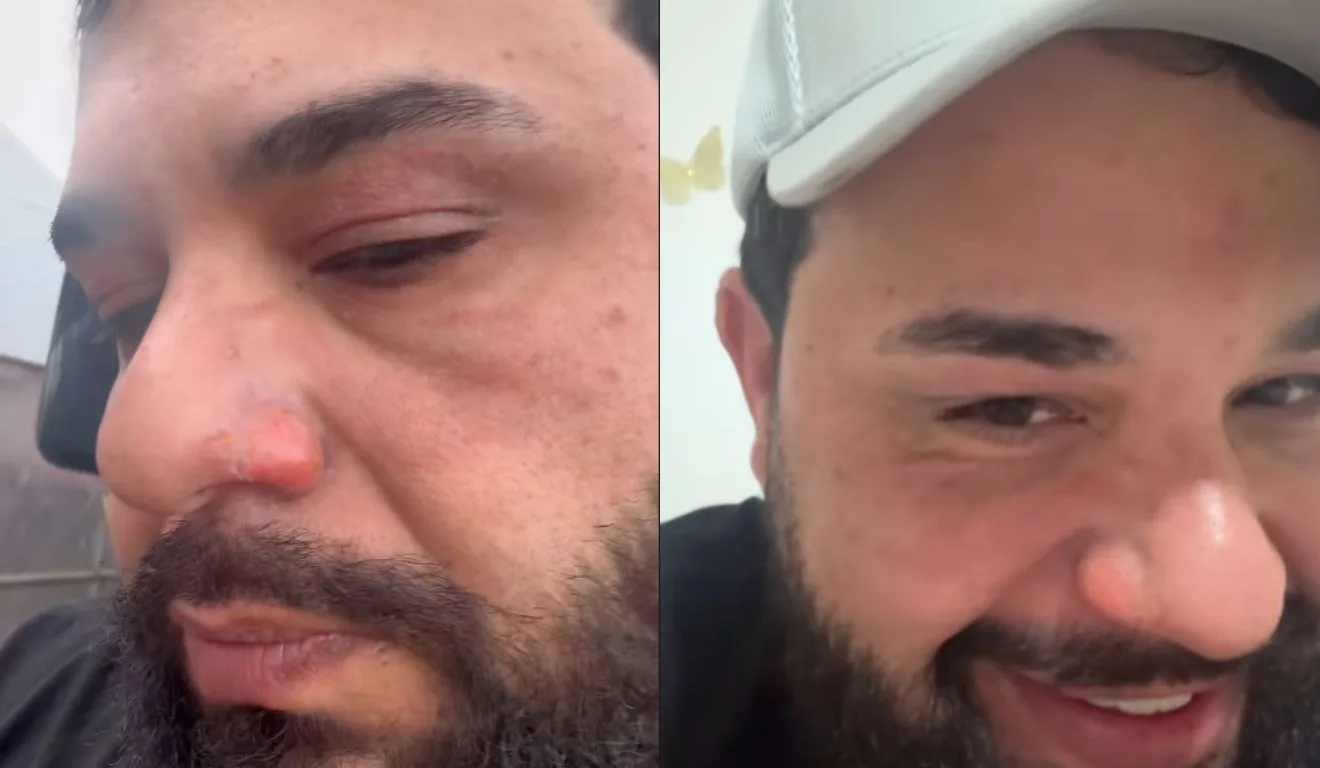 léo, dupla de raphael, mostrando rosto após pegar fogo