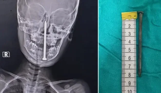 raio-x do prego cravado na cabeça de criança