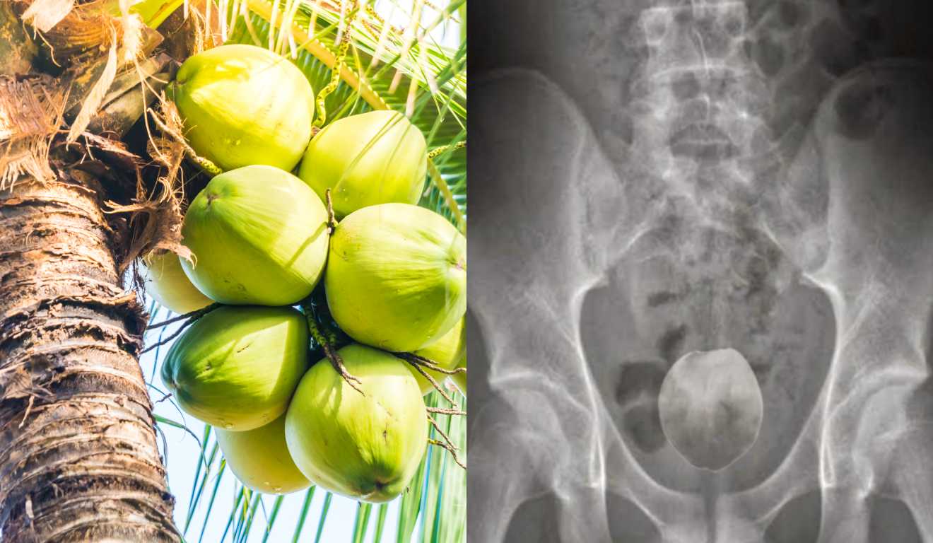 Uma imagem de coqueiro e um raio x com um coco no ânus de um homem