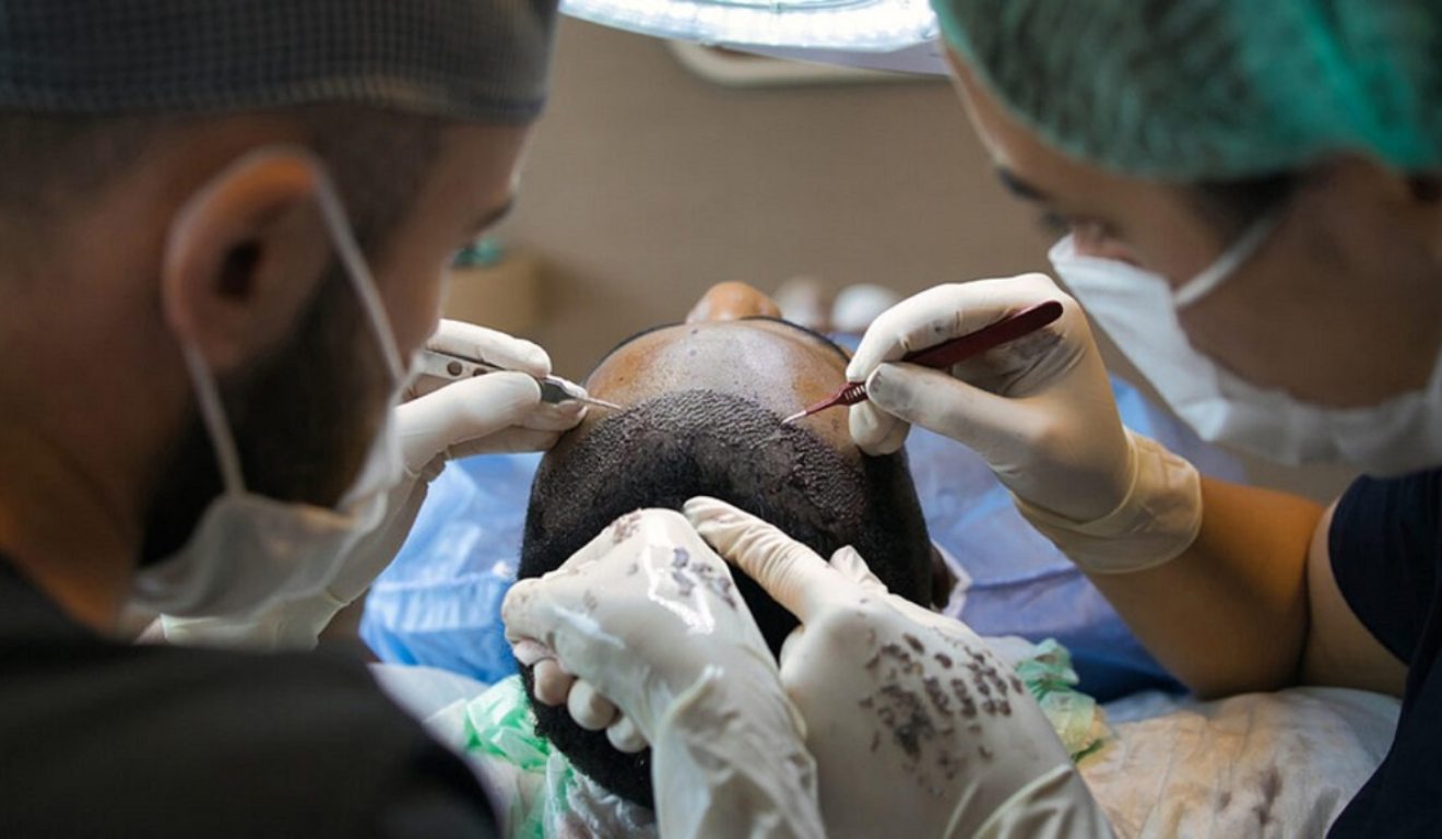Homem durante transplante capilar
