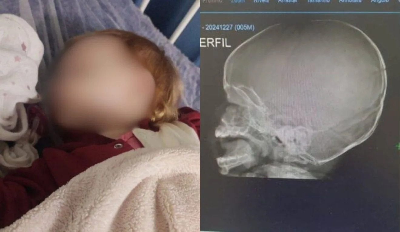 raio-x de bebê que caiu de trocador na creche