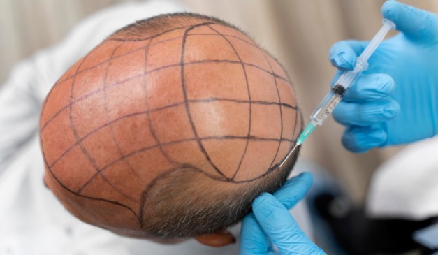 Homem realizando transplante capilar