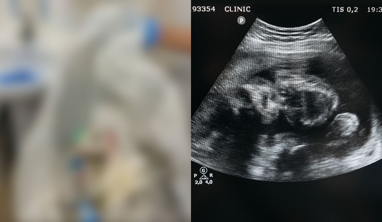 aborto clandestino em motel