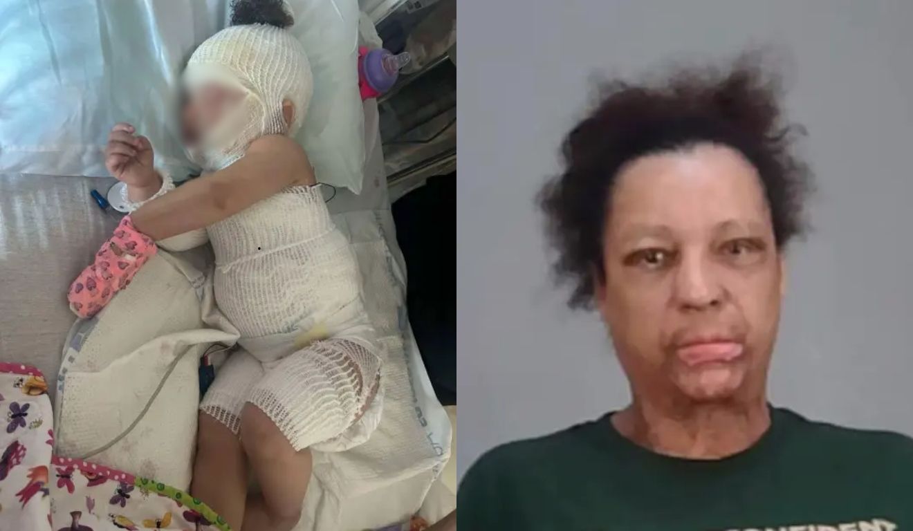 bebê queimada ao lado de babá que deu banho