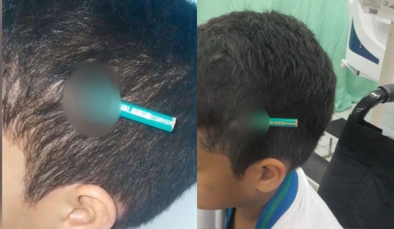 criança com lápis fincado na cabeça