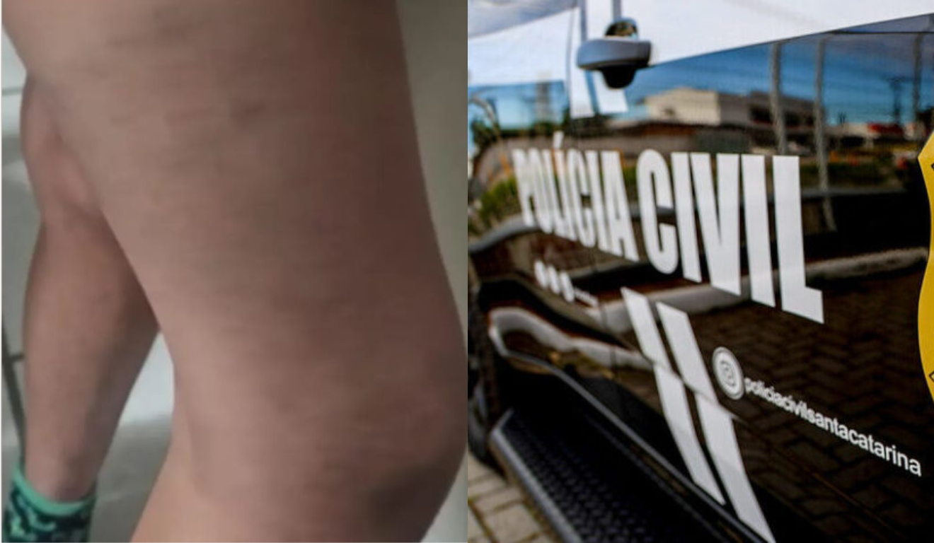 Imagem da perna machucada de uma das crianças e do carro da polícia.