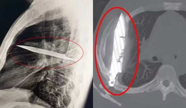 Raio-x do homem com faca alojada no peito