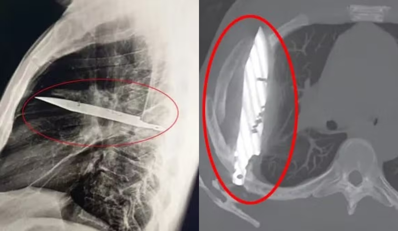 Raio-x do homem com faca alojada no peito