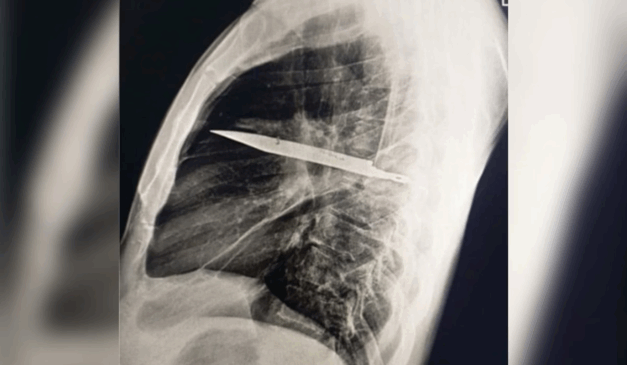 Imagem do raio-X que mostra que a faca estava no peito.