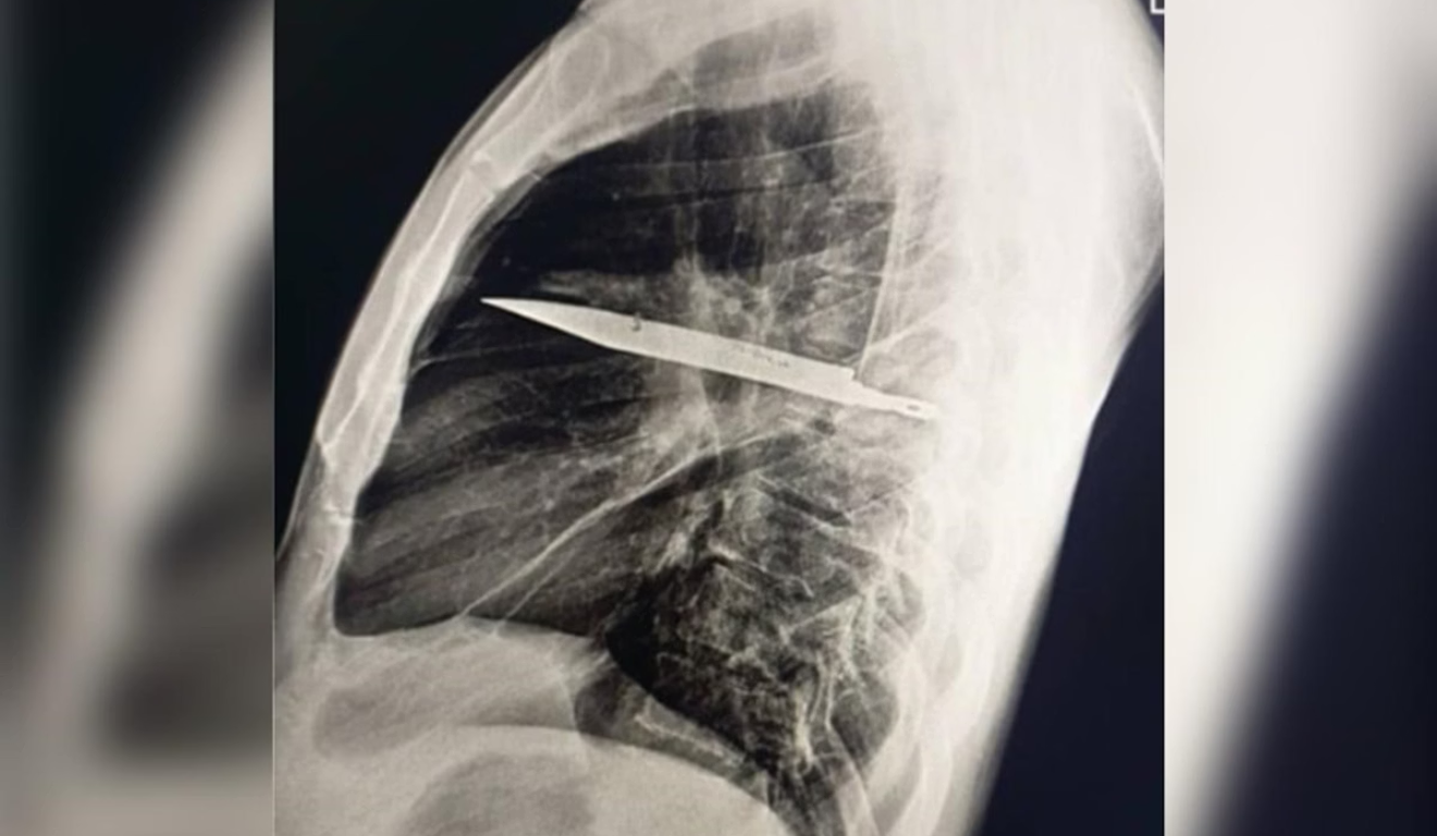 Imagem do raio-X que mostra que a faca estava no peito.