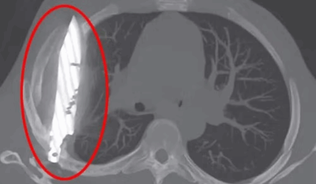 Imagem de raio-X que mostra a faca alojada no peito do homem.