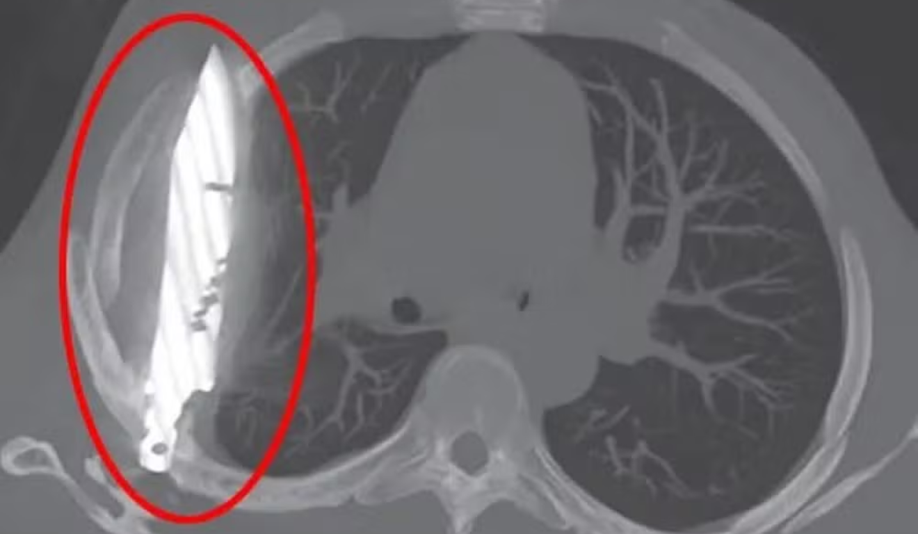 Imagem de raio-X que mostra a faca alojada no peito do homem.