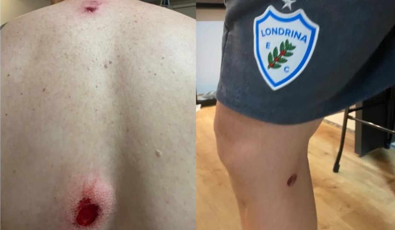 Jogador do Londrina levou tiro de bala de borracha