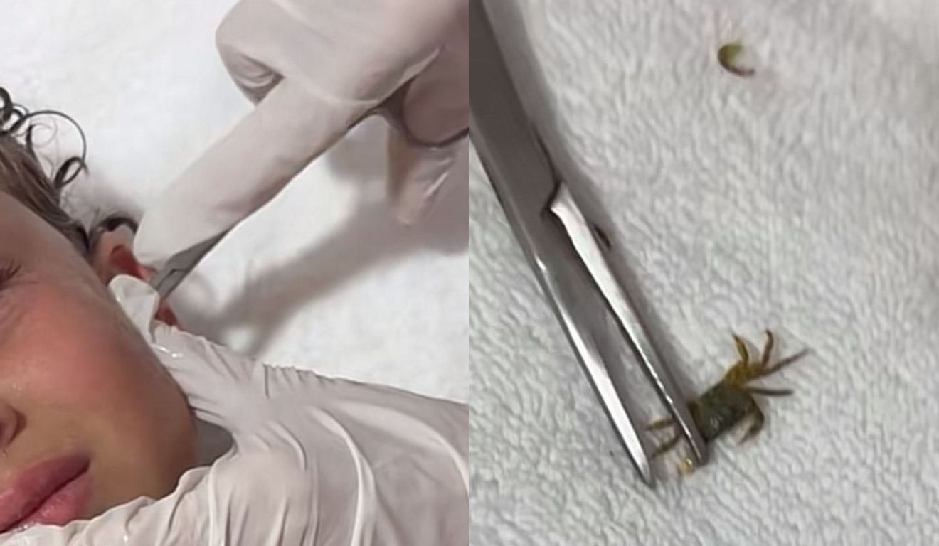 momento em que o caranguejo é retirado o do ouvido do menino