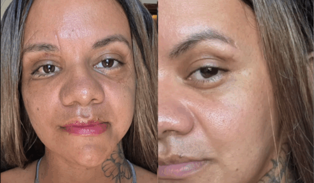 A mulher que foi espancada com 61 socos pelo namorado compartilhou o resultado da cirurgia nas redes sociais. Na imagem, vemos trechos do vídeo de resultados pós-operatórios.