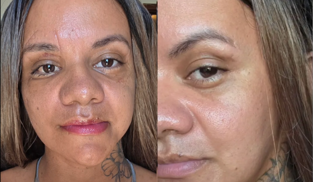 A mulher que foi espancada com 61 socos pelo namorado compartilhou o resultado da cirurgia nas redes sociais. Na imagem, vemos trechos do vídeo de resultados pós-operatórios.