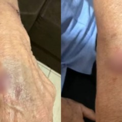 Mãos com machucados após filha ser suspeita de agredir mãe