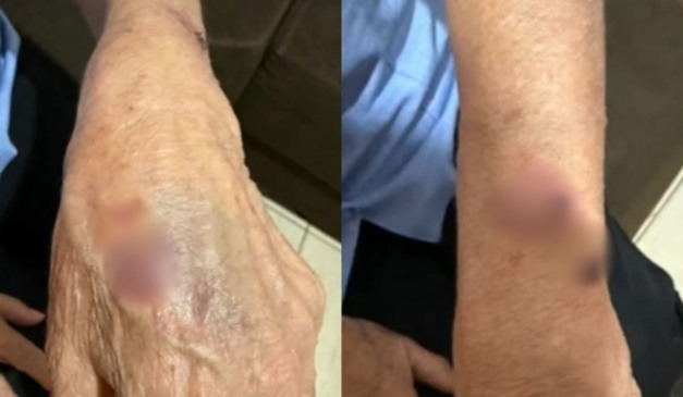 Mãos com machucados após filha ser suspeita de agredir mãe