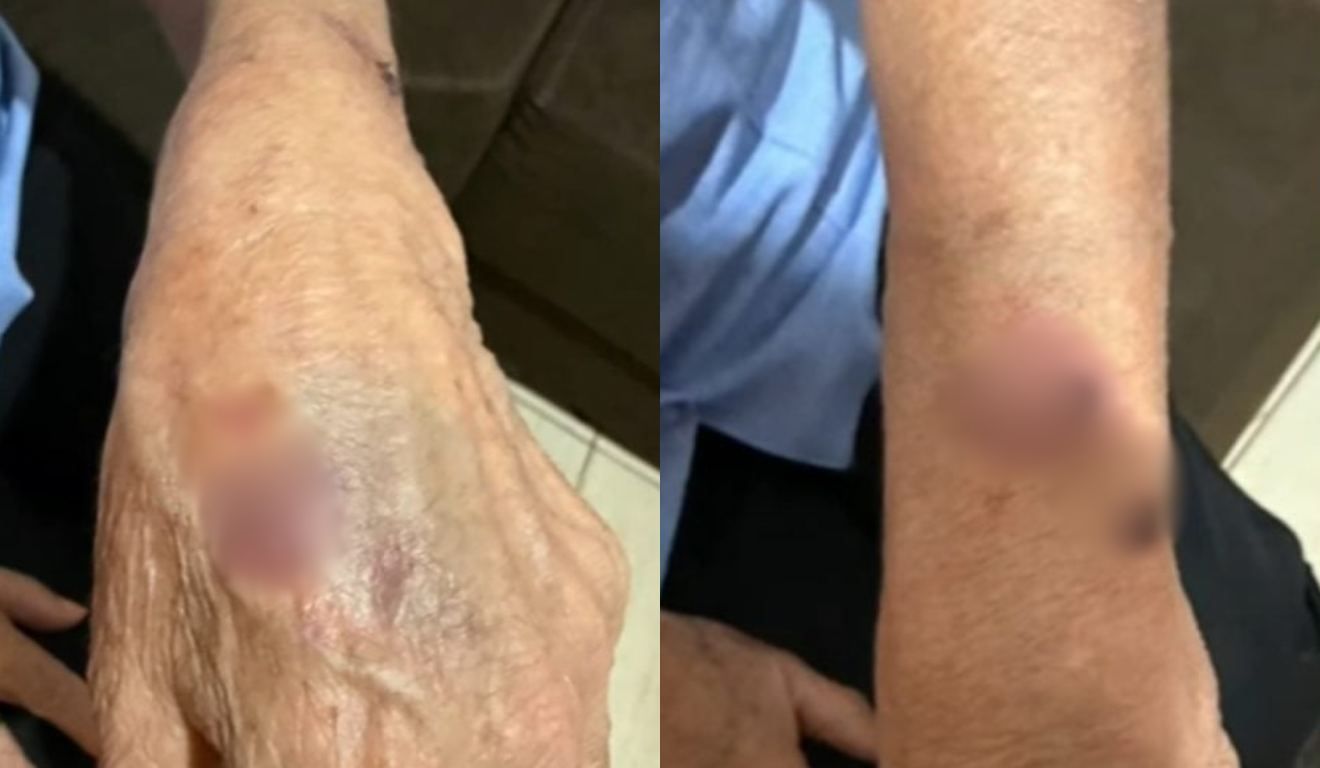 Mãos com machucados após filha ser suspeita de agredir mãe