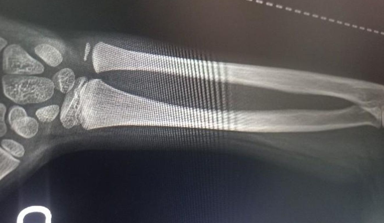 frautra do garoto após ser agredido pela mãe com cabo de vassoura