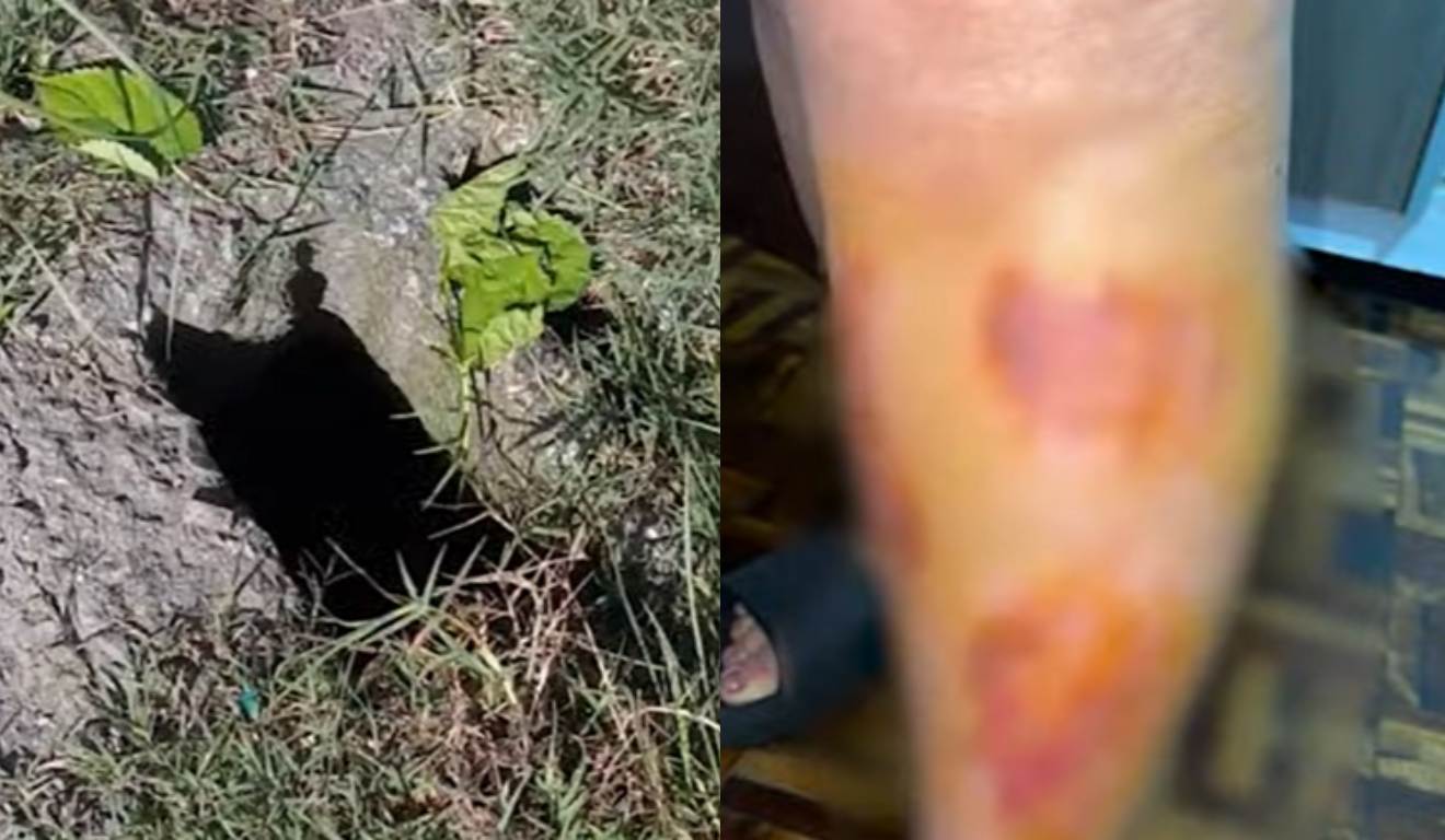 colagem com fotos que mostram bueiro sem tampa e ferimentos de moradora que caiu no buraco em curitiba