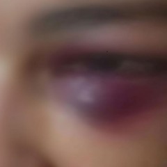 esposa com olho roxo após ser espancada pelo marido durante 12 horas