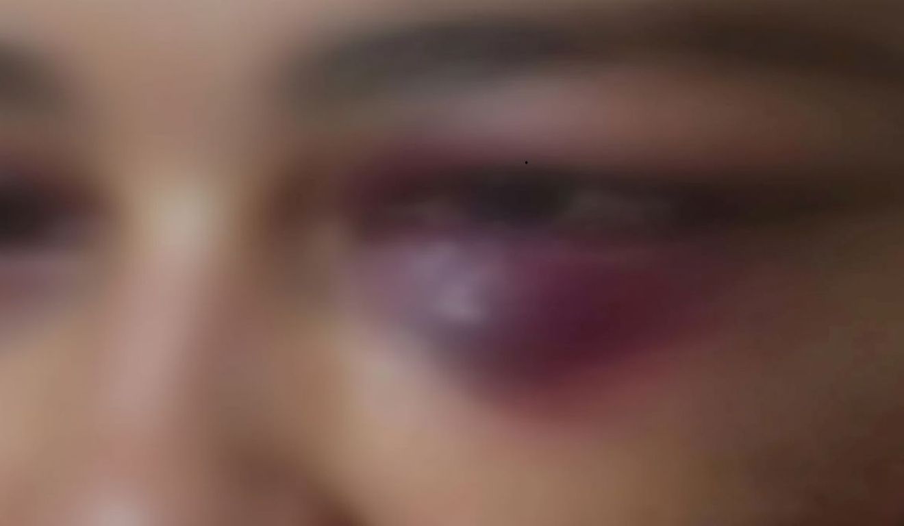 esposa com olho roxo após ser espancada pelo marido durante 12 horas