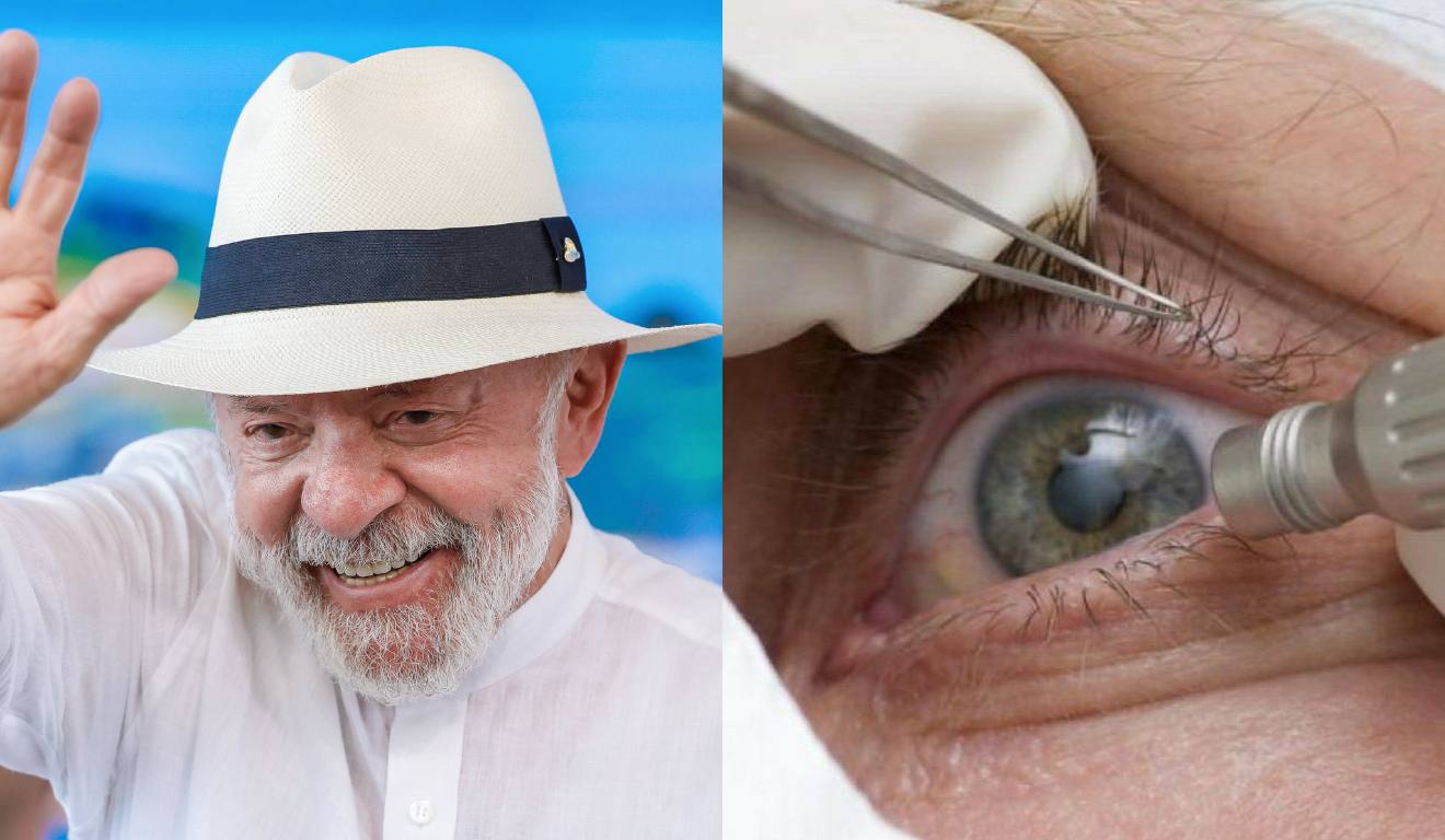 Colagem de fotos mostra o presidente Luiz Inácio Lula da Silva e o olho de um paciente que passou por cirurgia de catarata